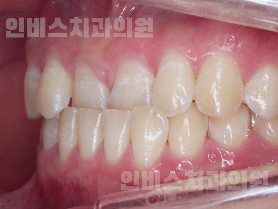 부정교합 교정 전