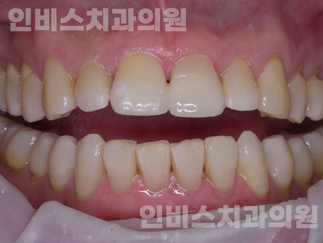 무삭제 라미네이트 후 2
