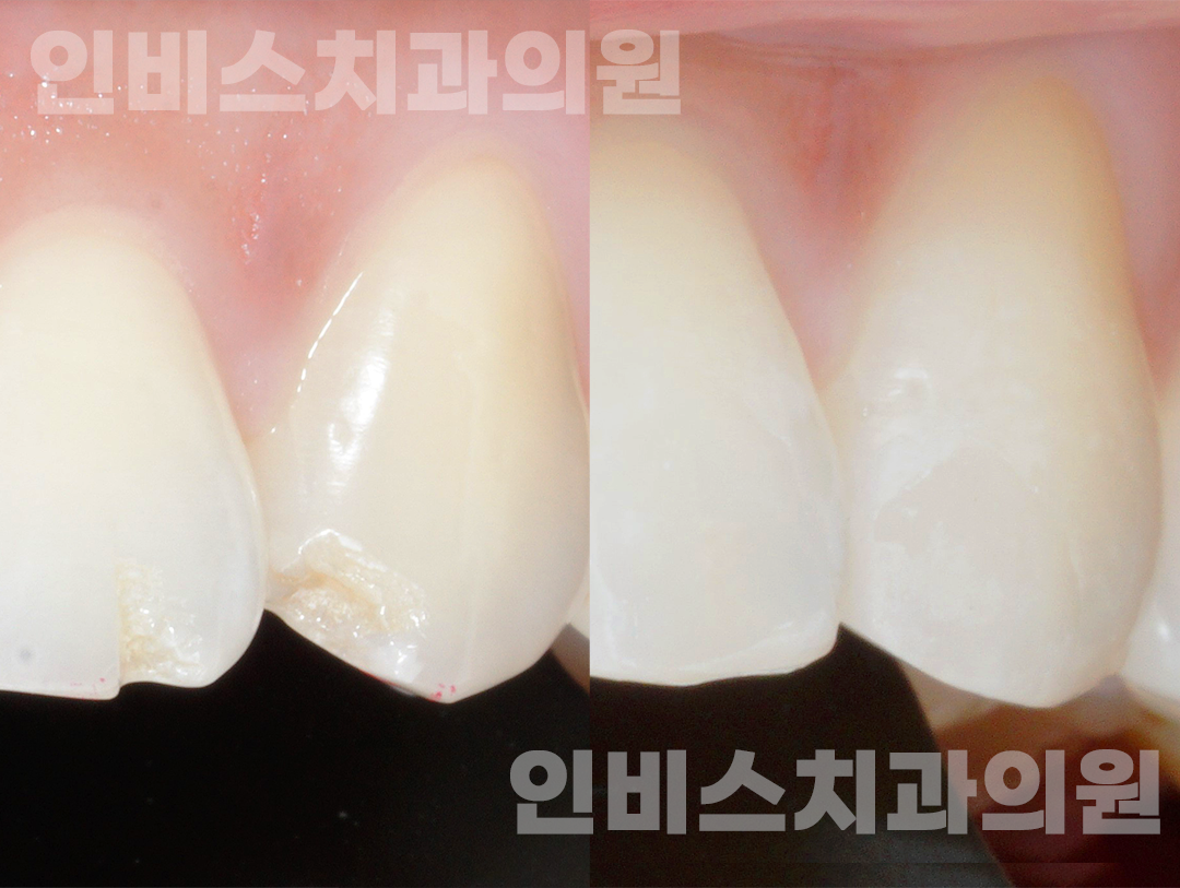 심미 보철 후 2